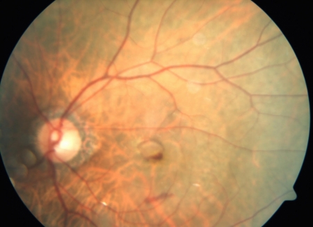 Fig 11. Wet type of macular degeneration